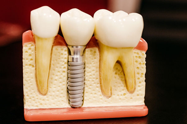 Implant Crowns